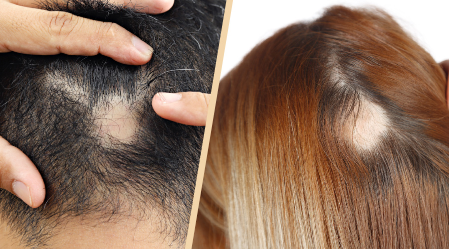 exempel på alopecia exempel-pa-alopecia